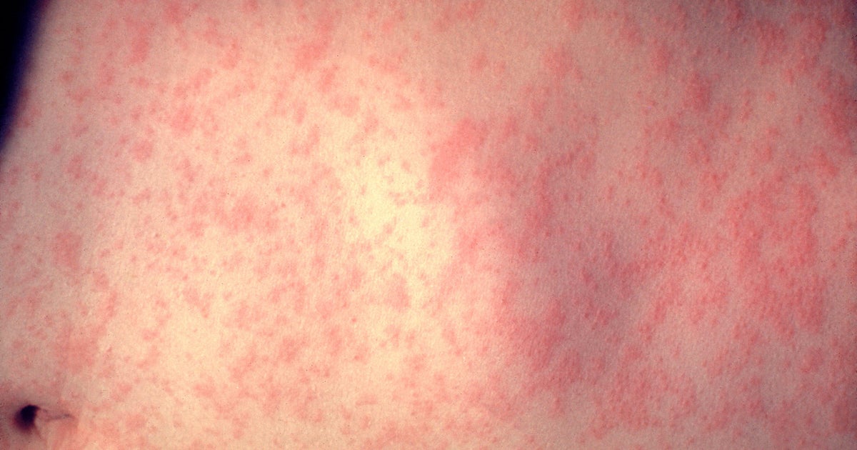 3 measles cases reported in southeastern Minnesota