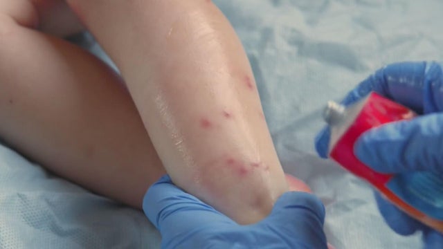 2nd case of measles confirmed in Allegheny County