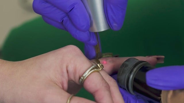 More South Florida tattoo clients are paying to get them removed