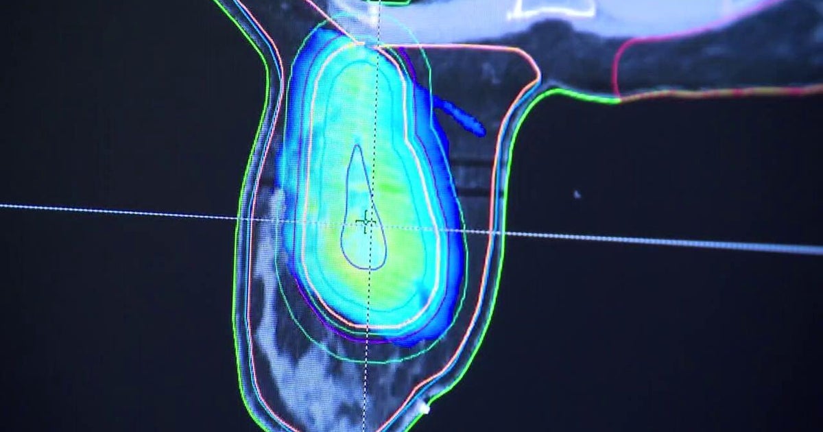 AI-assisted adaptive radiation therapy acts like a GPS as it targets areas impacted by breast cancer, doctors say