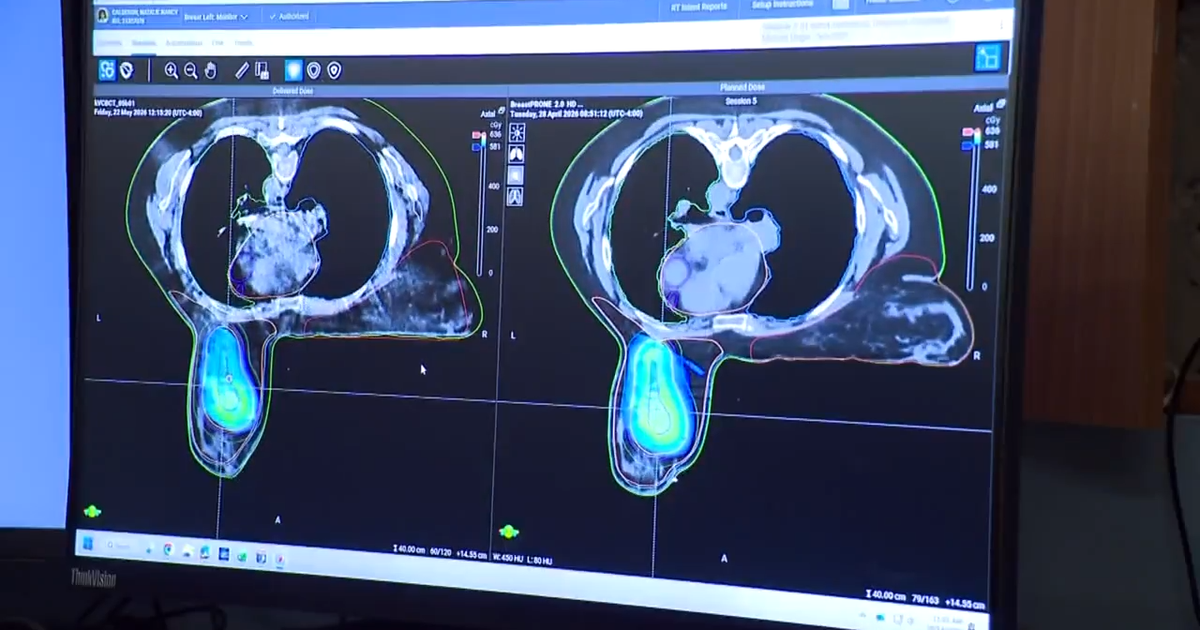 New technique uses artificial intelligence to fight breast cancer