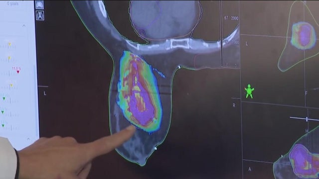 New breast cancer treatment tool uses AI