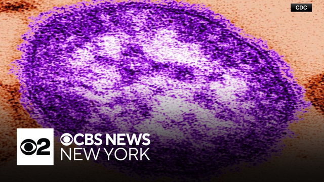 Second case of measles confirmed on Long Island, health officials say