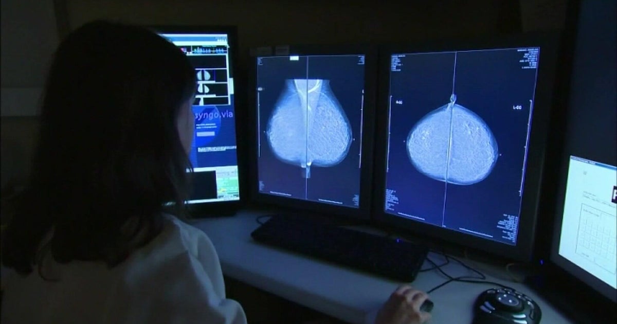 Rocklin woman stresses importance of breast cancer screenings as cases rises among younger women