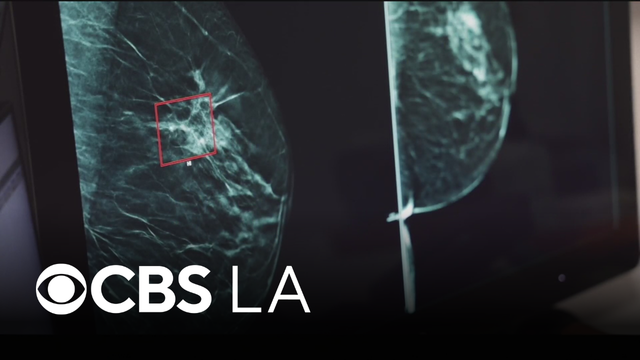 More women under 45 years old diagnosed with breast cancer than ever before