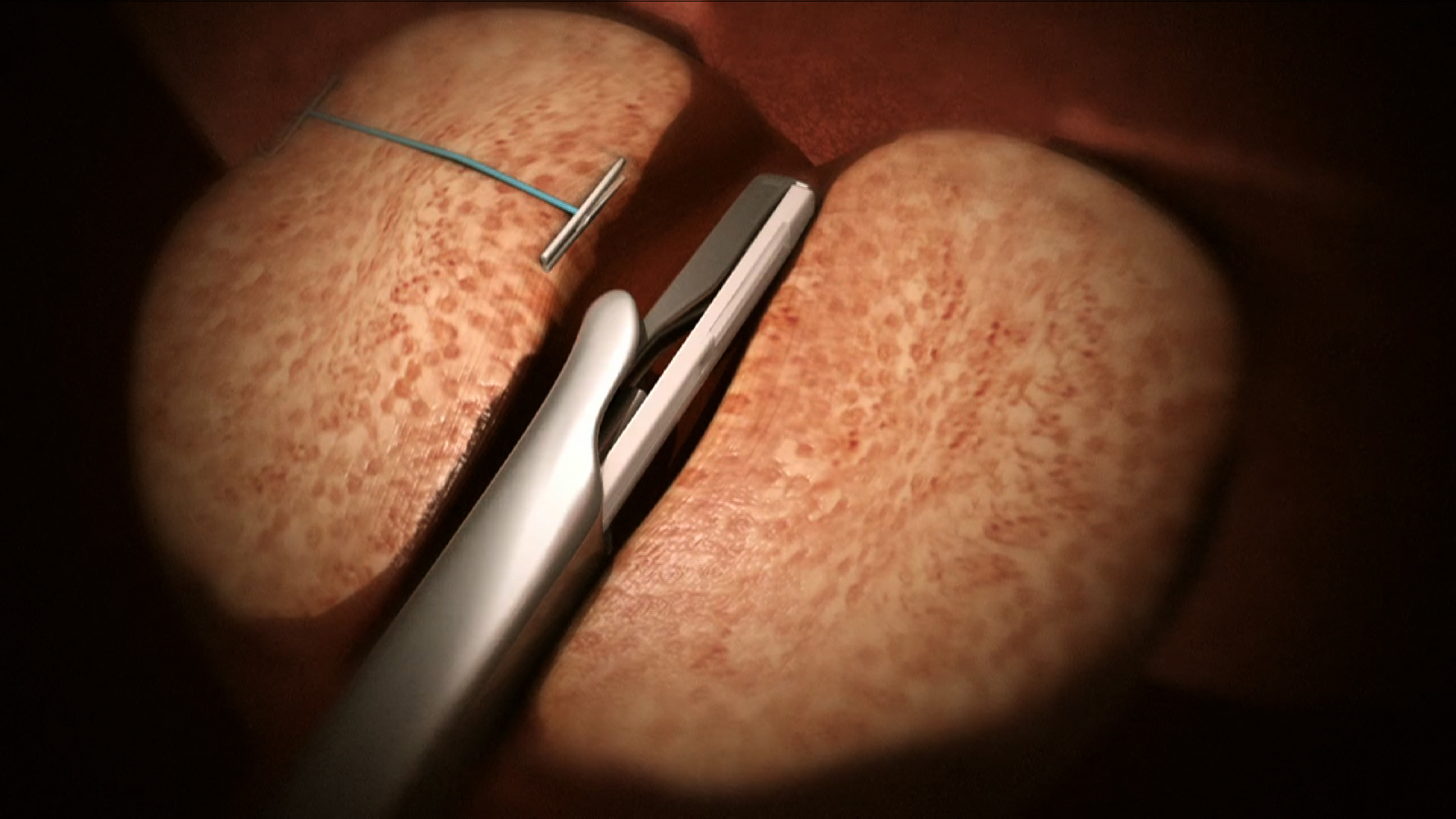 Minimally Invasive Urolift Procedure A New Option For Men With