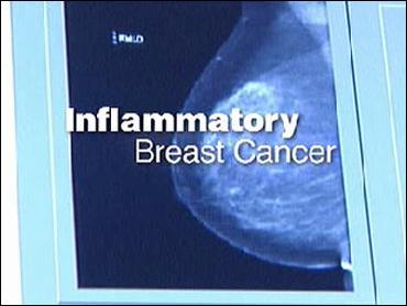 Curious About Detecting Inflammatory Breast Cancer